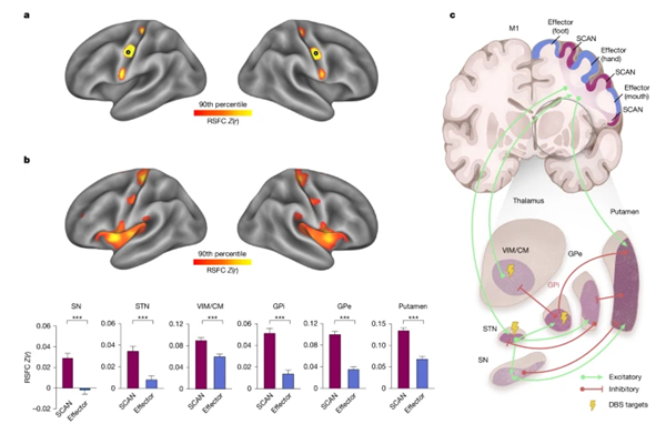 Groundbreaking study identifies core brain network in Parkinson's disease
